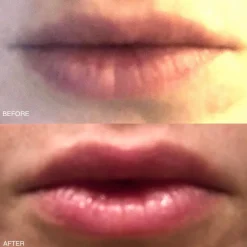 High Performance Lip Filler